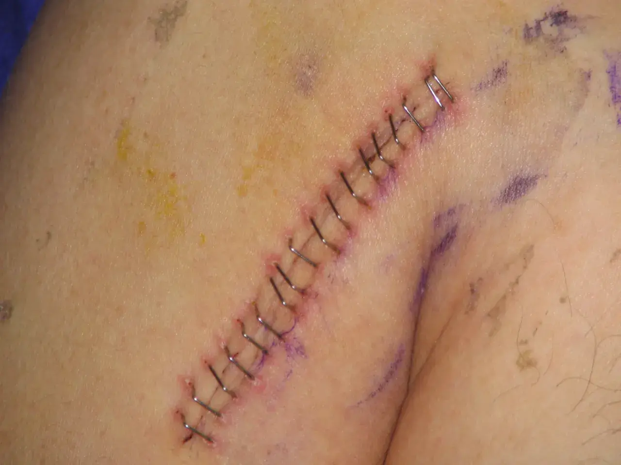 Gros plan sur une cicatrice suturée avec des agrafes chirurgicales. Un point de suture qui saute est visible, indiquant une possible complication.