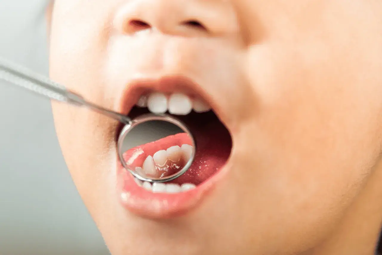 Bambino con bocca aperta e specchietto dentale. Si intravedono i denti, ma l'immagine suggerisce la preoccupazione per i denti marci nei bambini.