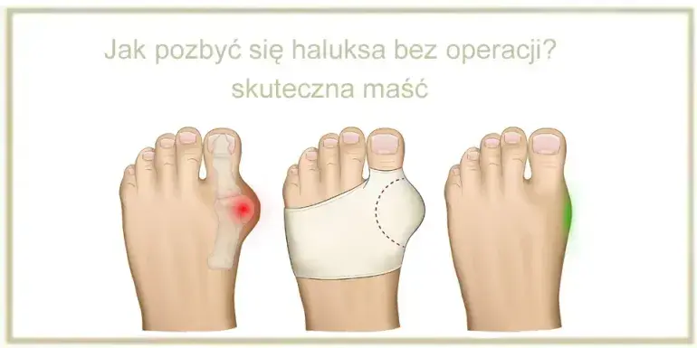 Bolące haluksy: Szybka ulga i skuteczne leczenie co działa?