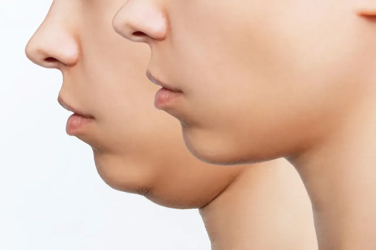 Perfil de un rostro mostrando la reducción de la papada.
