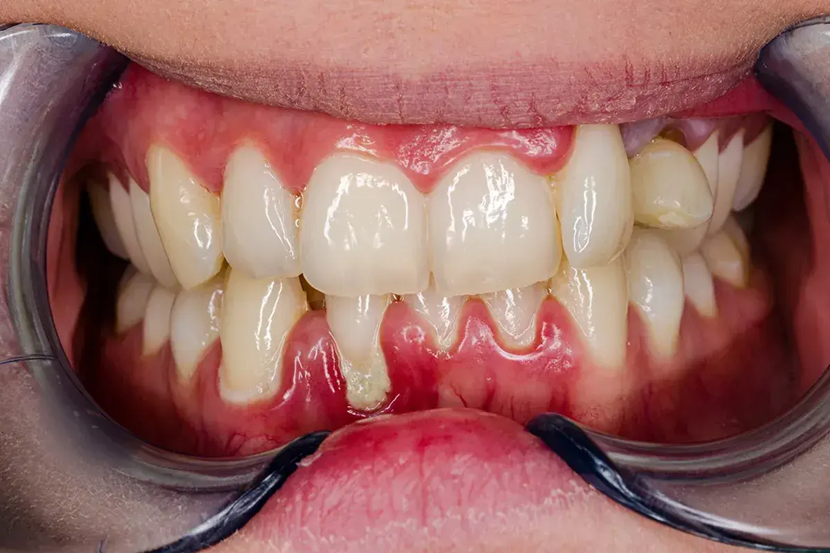 Gengive gonfie e arrossate, segno di gengivite acuta. Si nota un accumulo di placca tra i denti.