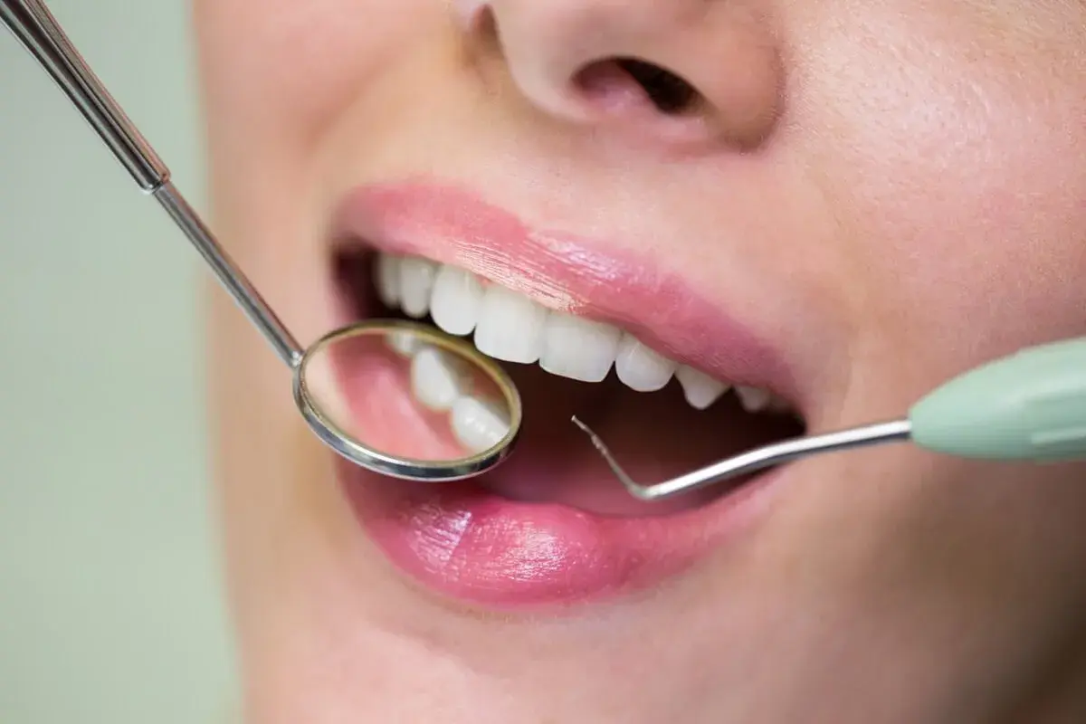 Usta kobiety z białymi zębami, badane lusterkiem dentystycznym. Na dziąśle widoczna jest mała, biała kulka.