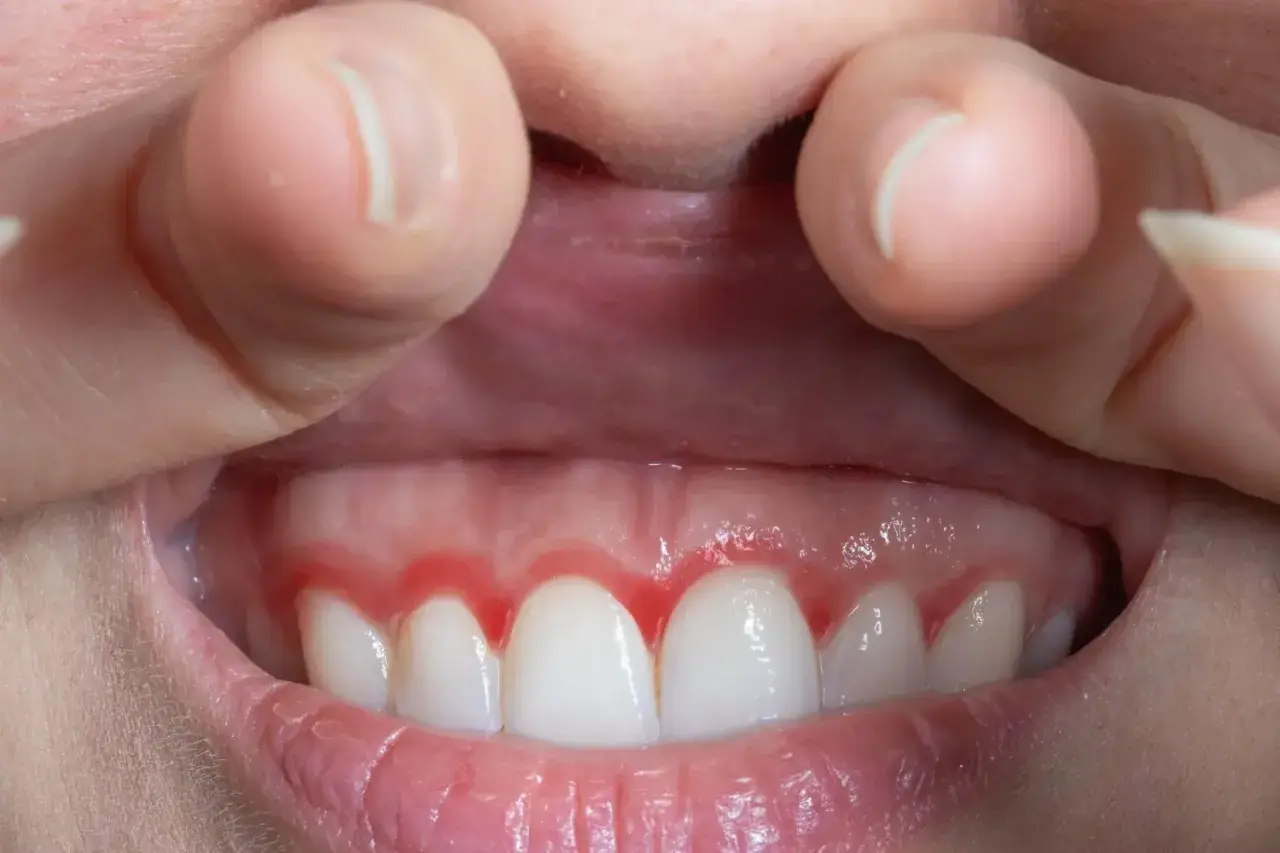 Dientes blancos con encía roja e inflamada alrededor.