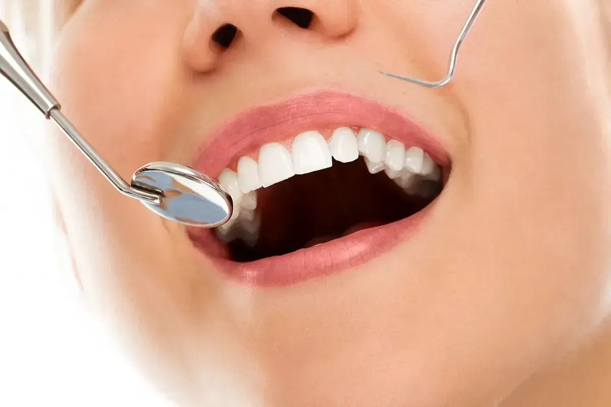 Uśmiechnięte usta z białymi zębami, lustro dentystyczne i sonda. Zabieg kiretaż może pomóc w osiągnięciu takiego efektu.