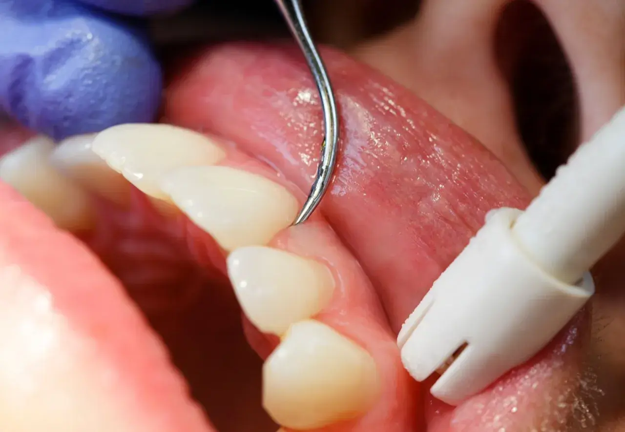 Detalles de un tratamiento dental para como tratar la gingivitis. Se observa un instrumento dental limpiando la línea de las encías.