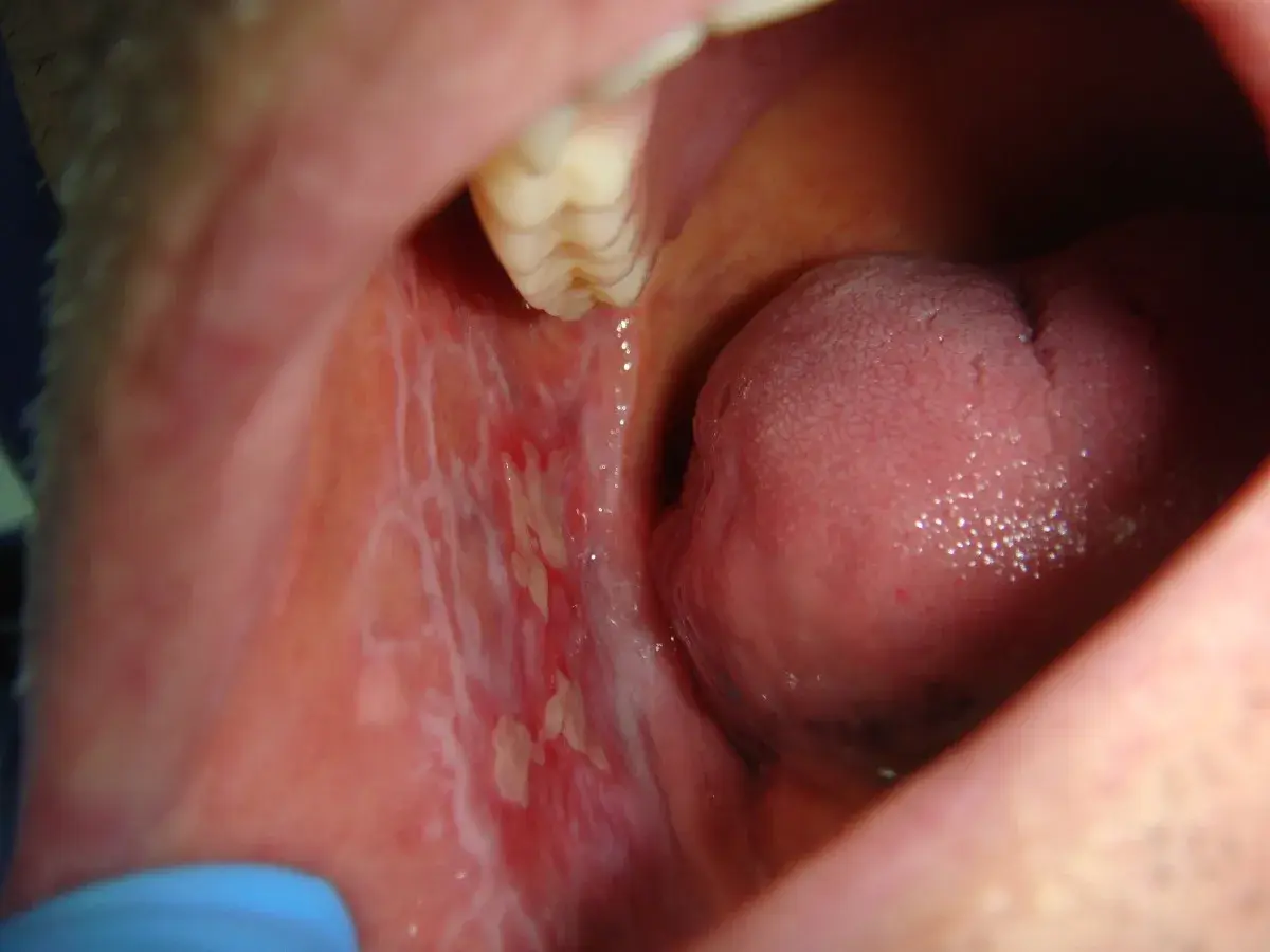 Lesioni biancastre e arrossate all'interno della bocca, possibili sintomi di lichen planus da stress.