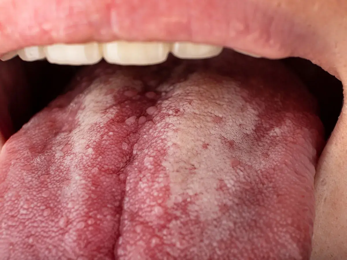 Lengua con manchas rojas y aspecto blanquecino, indicando posibles manchas rojas en la lengua y dolor de garganta.