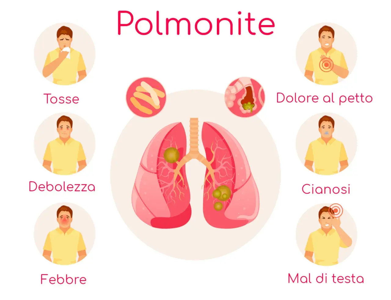 Polmonite: tosse, debolezza, febbre, dolore al petto, cianosi, mal di testa. L'immagine illustra i sintomi della polmonite, inclusa la polmonite ab ingestis.