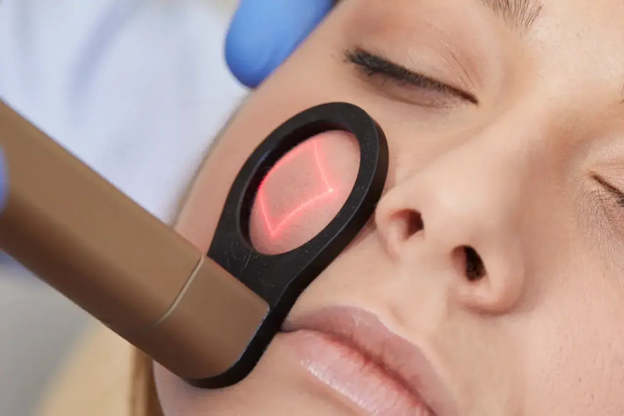 Närbild på ett ansikte som får laserbehandling. En hand med blå handske håller en apparat som riktar en röd laserstråle mot kinden.