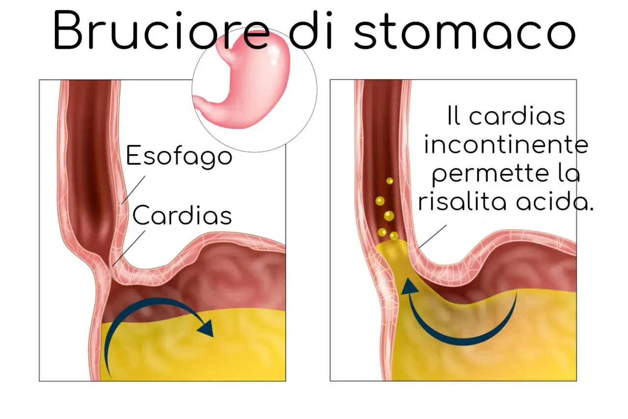 Illustrazione del bruciore di stomaco: il cardias incontinente permette la risalita acida, causando fitte allo stomaco.