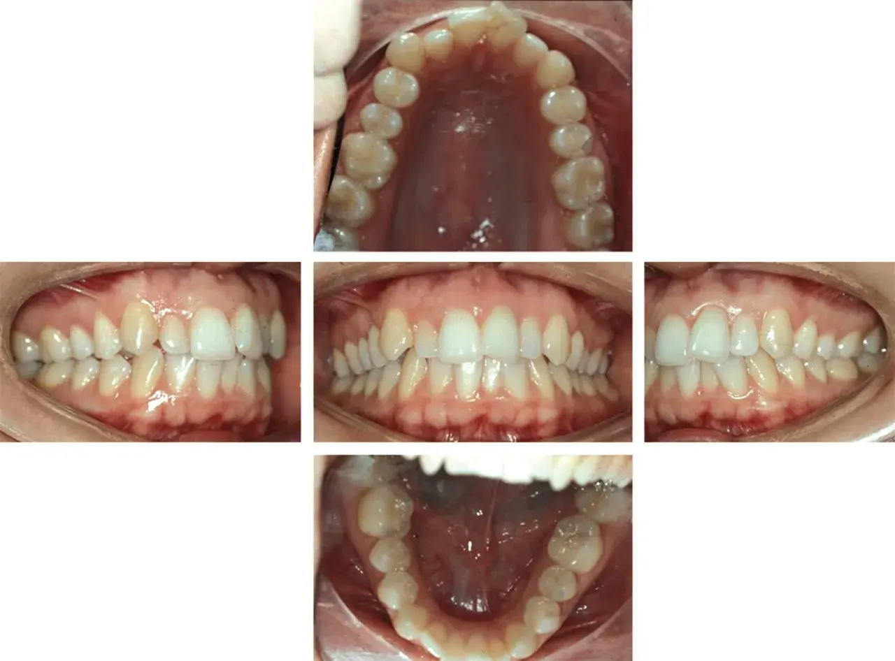 Denti con malocclusione 2 classe, in attesa di trattamento Invisalign.