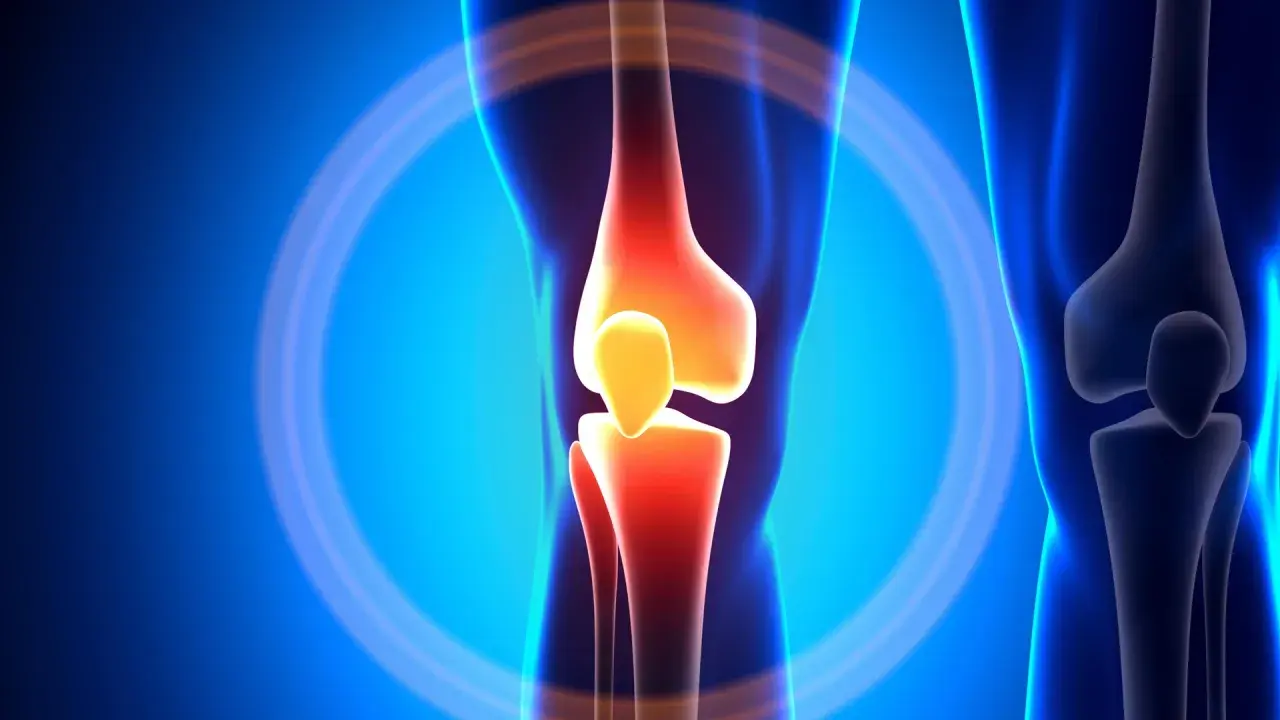 Schmerzendes Knie mit entzündeten Knochen, ein Symbol für die "unhappy triad" des Knies.