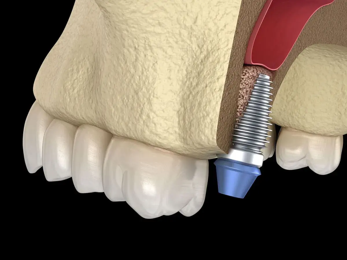 Impianto dentale vicino al seno mascellare. Il rialzo seno mascellare presenta rischi, ma questa immagine mostra la procedura.