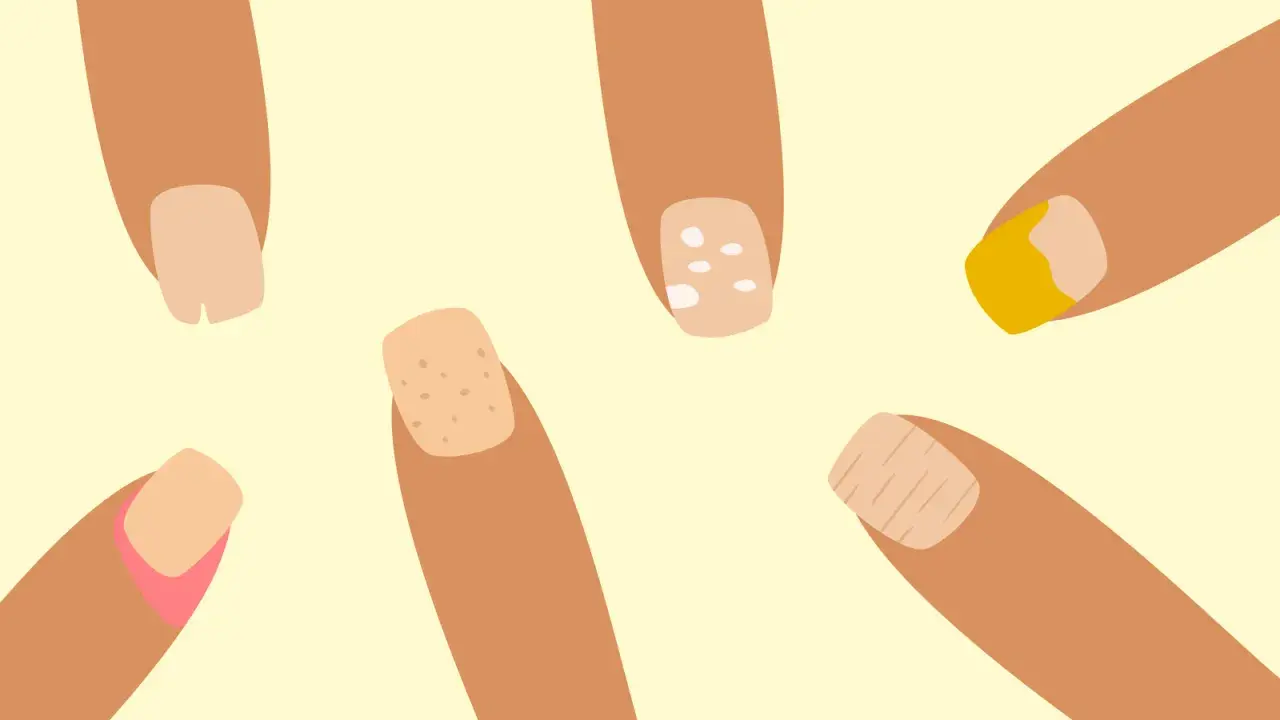 Illustration av fingrar med olika naglar. En nagel har vita prickar, en annan ser ut att ha en sjukdom.