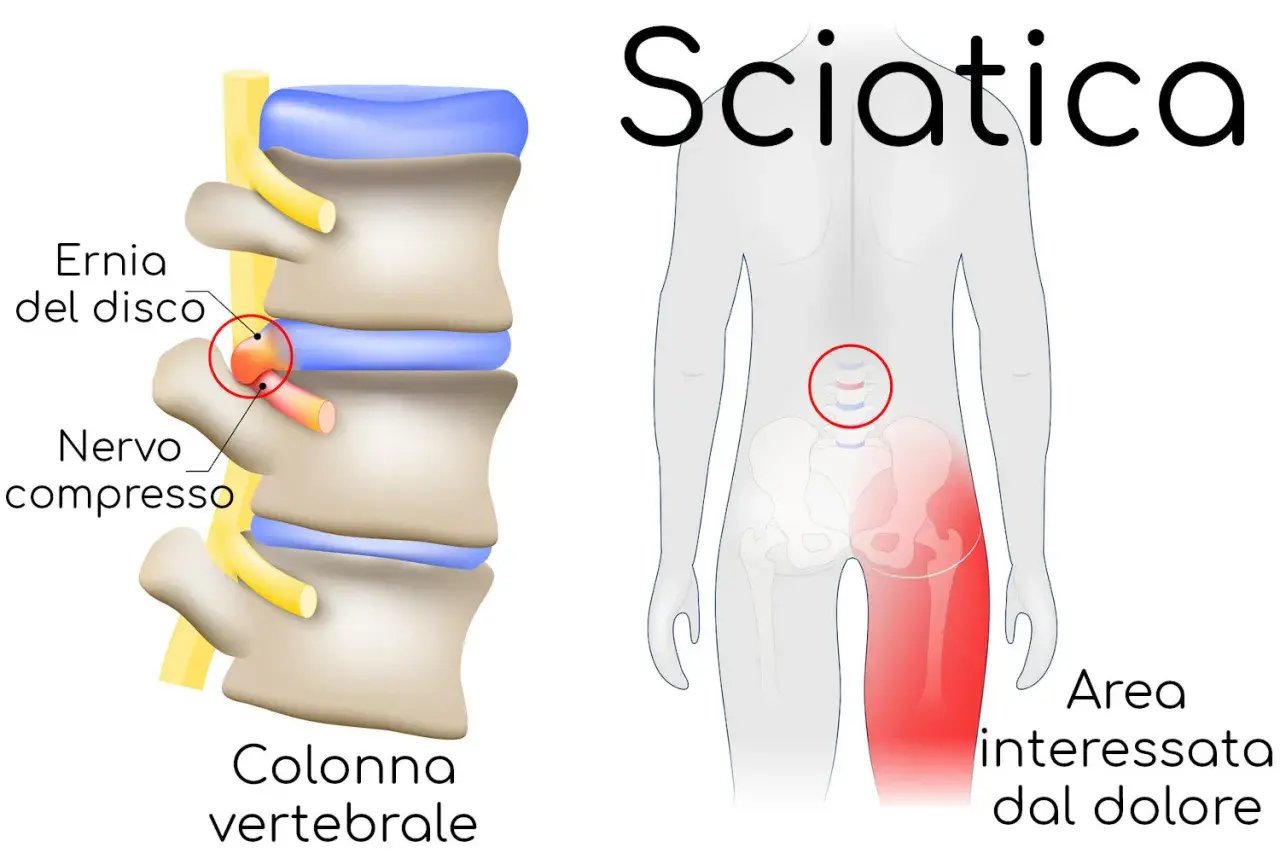Illustrazione della colonna vertebrale con ernia del disco che comprime un nervo, causando dolore all'area interessata. La durata della sciatica varia.