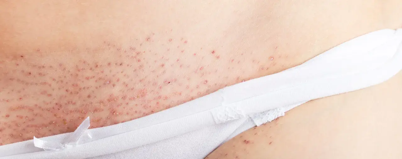 Hudirritation med små röda prickar och rakfinnar underlivet, synligt nära en vit troskant.