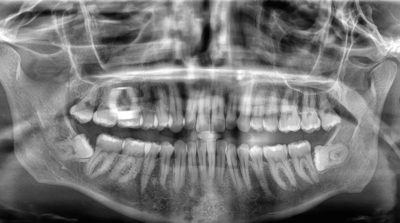 Radiografía panorámica dental. Se observa una muela del juicio impactada, inclinada hacia la mejilla, con posible presión sobre el diente adyacente.