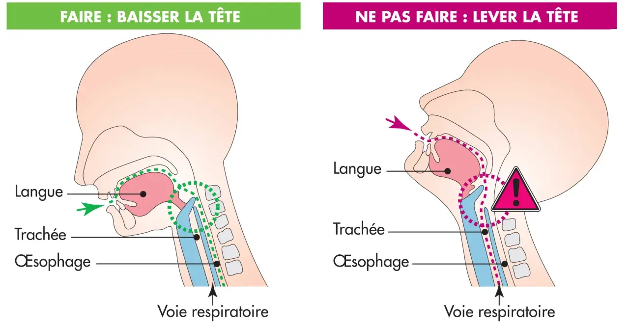 Illustration montrant la bonne (tête baissée) et la mauvaise (tête levée) position pour manger, afin d'éviter la difficulté à avaler et l'obstruction des voies respiratoires.
