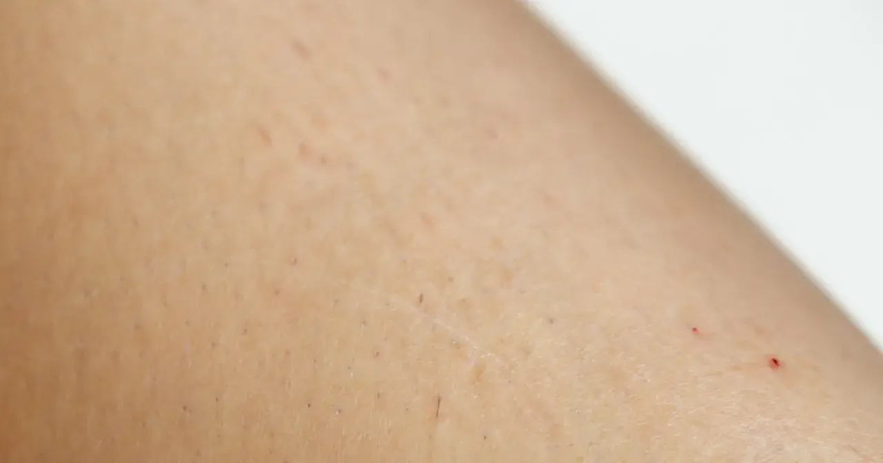 Skóra z drobnymi czerwonymi kropkami i nierównościami, charakterystycznymi dla rogowacenia mieszkowego (keratosis pilaris).