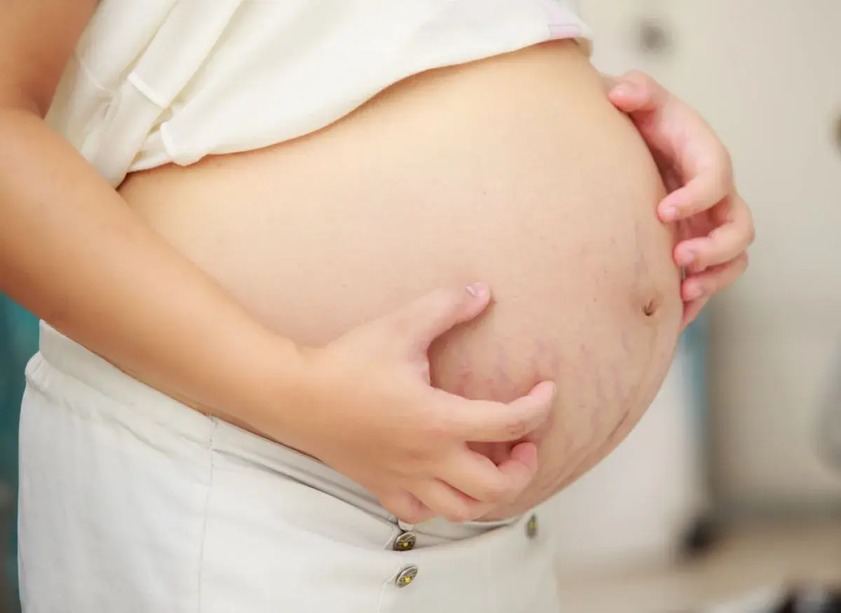 Ventre de femme enceinte avec vergetures, une main se gratte. Le ventre qui gratte signification est souvent liée à l'étirement de la peau.