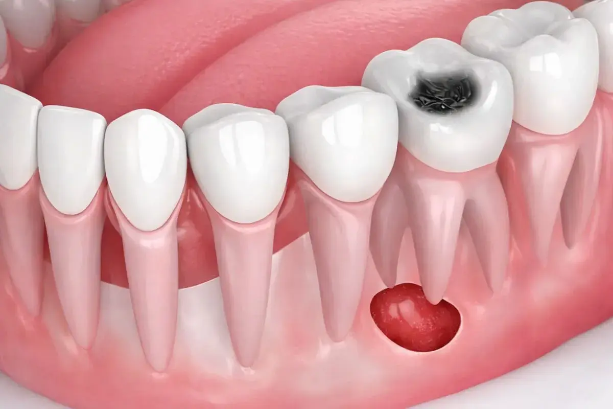 Diente con caries y un quiste odontogénico en la encía.
