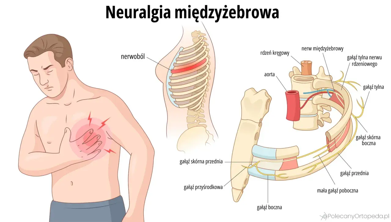 Mężczyzna odczuwa ból mostka, ilustracja pokazuje unerwienie żeber i kręgosłupa, wyjaśniając neuralgię międzyżebrową.
