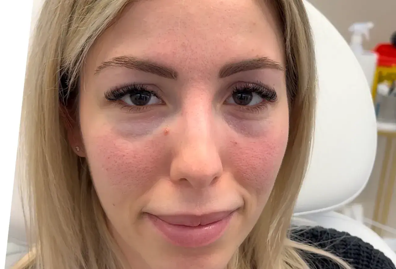 Ansiktsbild av en kvinna med synliga porer och rodnad. Hon har mörka ögonfransar och ljusblont hår. Under ögonen syns en antydan till mörka ringar, vilket kan behandlas med tear trough filler.