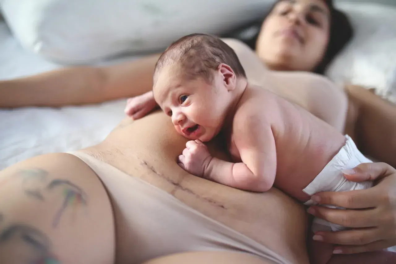Nyfödd bebis på mammas mage med ärr efter kejsarsnitt. Hud mot hud-kontakt för att främja läkning och anknytning.
