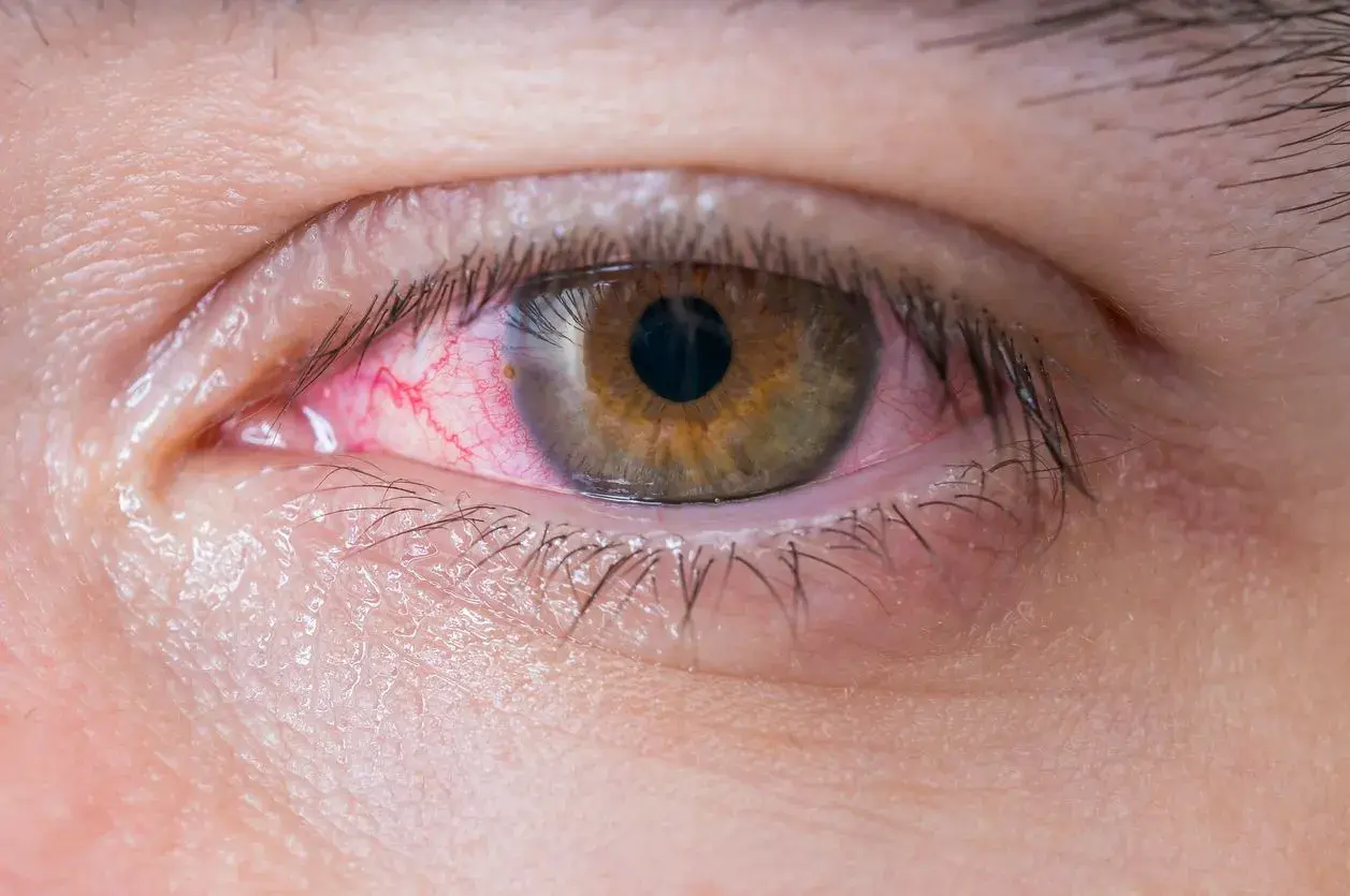 Ojo irritado con venas rojas visibles. Parece el ojo de un niño con ojos rojos por alergia o conjuntivitis.