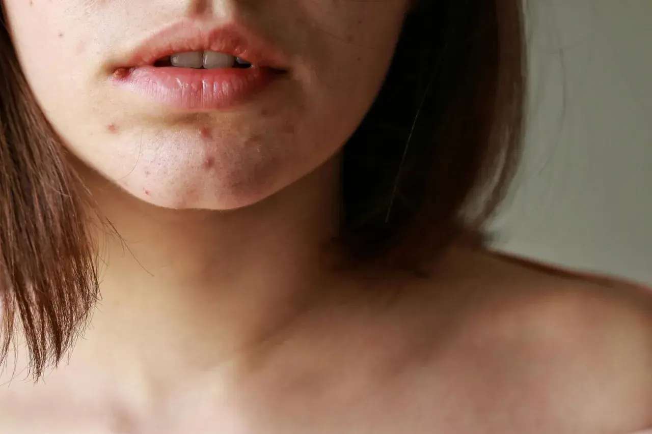 Nahaufnahme von Lippen und Kinn mit Pickeln, die auf Hautveränderungen in den Wechseljahren hindeuten.