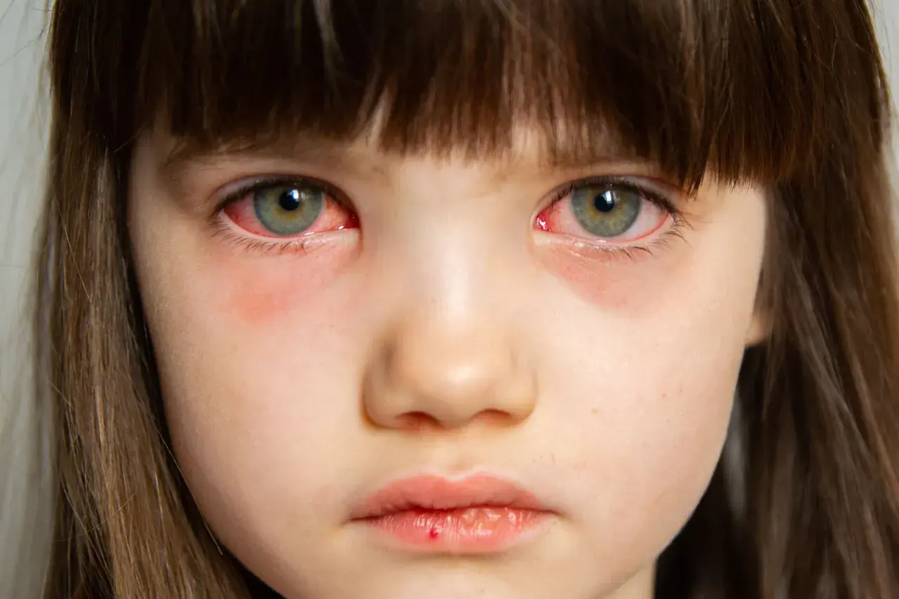 Primer plano de los ojos rojos e irritados de una niña, síntoma común de conjuntivitis en niños.