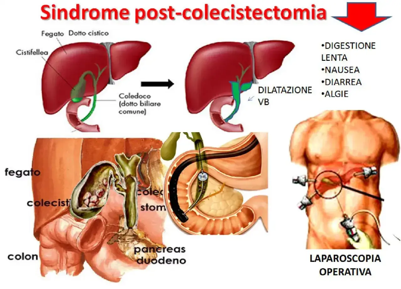 Illustrazione della sindrome post-colecistectomia, con diagrammi del fegato, cistifellea e vie biliari, e immagini di chirurgia laparoscopica. Vivere senza cistifellea può comportare disturbi digestivi.