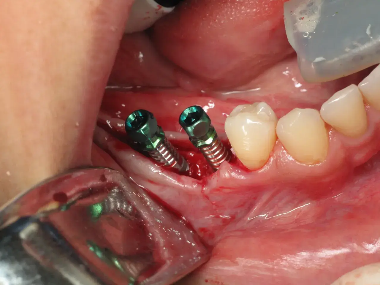 Due viti per impianto dentale sono visibili nella gengiva, pronte per la guarigione. Il dolore post-operatorio è comune, ma gestibile.