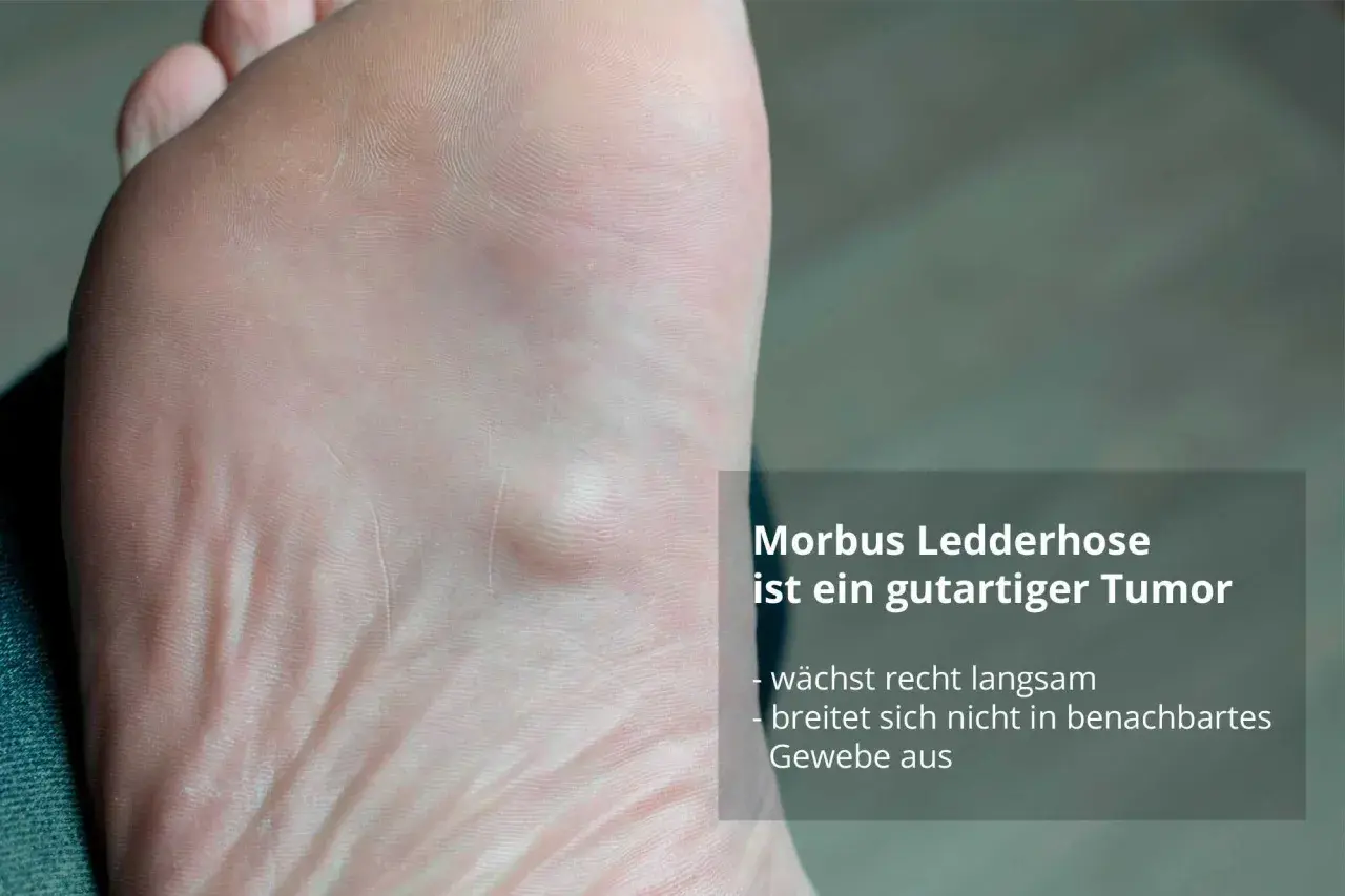 Fußsohle mit Knoten, typisch für Morbus Ledderhose bei Frauen. Der gutartige Tumor wächst langsam.