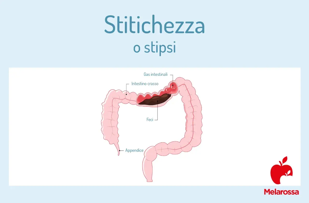 Illustrazione del colon con feci accumulate e gas intestinali, che indica stitichezza. Una purga intestinale potrebbe aiutare.
