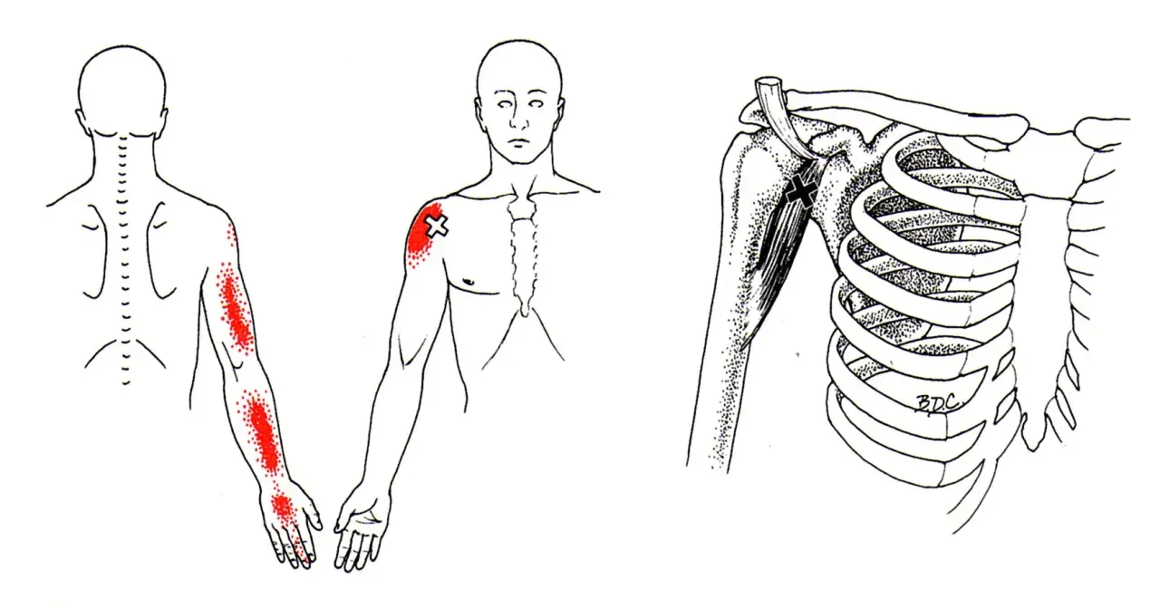 Schmerzpunkte am Arm und Schulterbereich, die auf den m coracobrachialis hinweisen. Detailansicht des Schultergelenks mit Muskeln und Rippen.