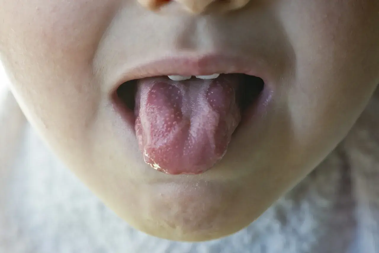 Lingua di bambino con piccole vescicole, possibile sintomo di stomatite.