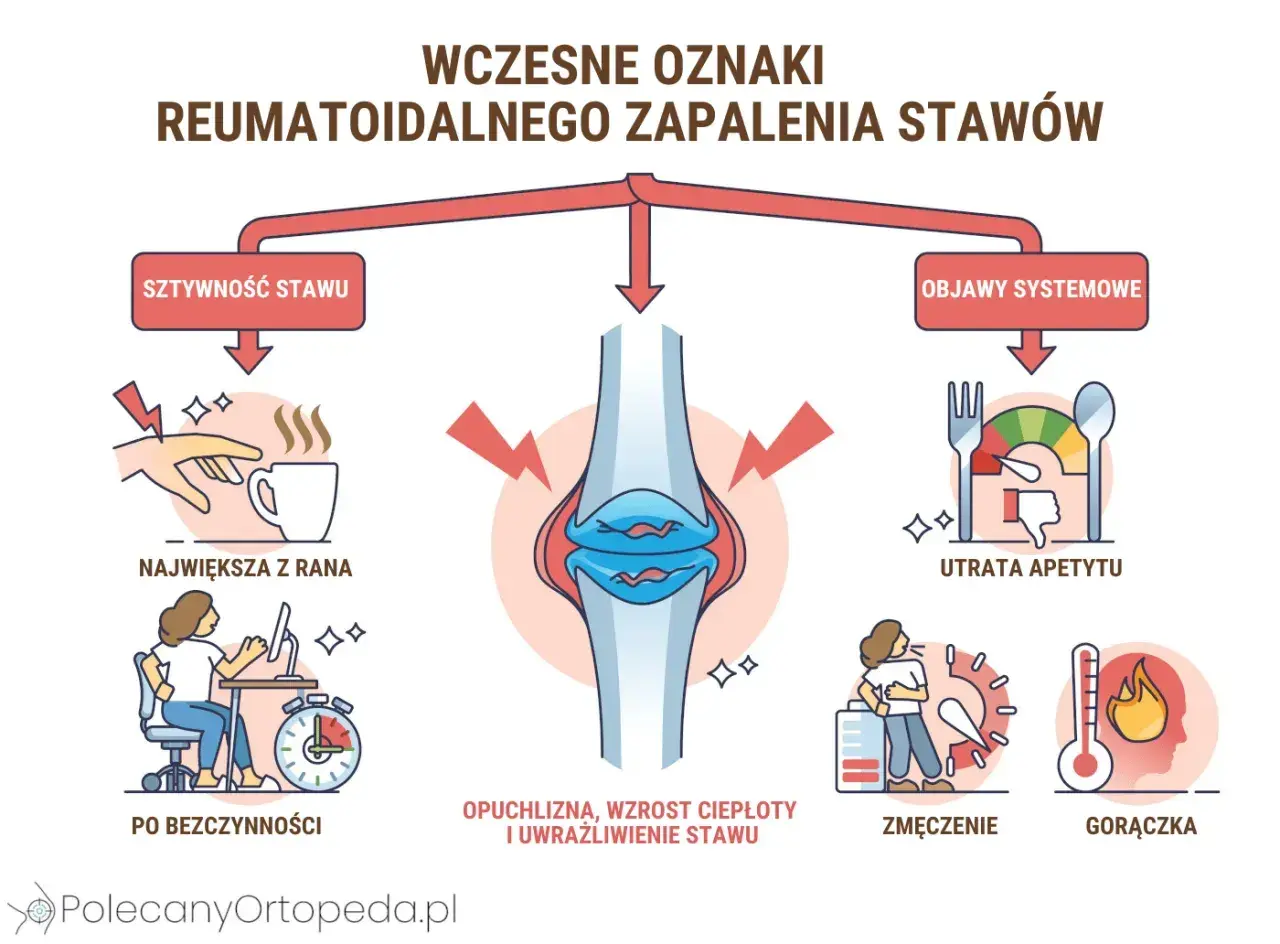 Wczesne objawy wirusowego zapalenia stawów: sztywność, opuchlizna, utrata apetytu, zmęczenie, gorączka.