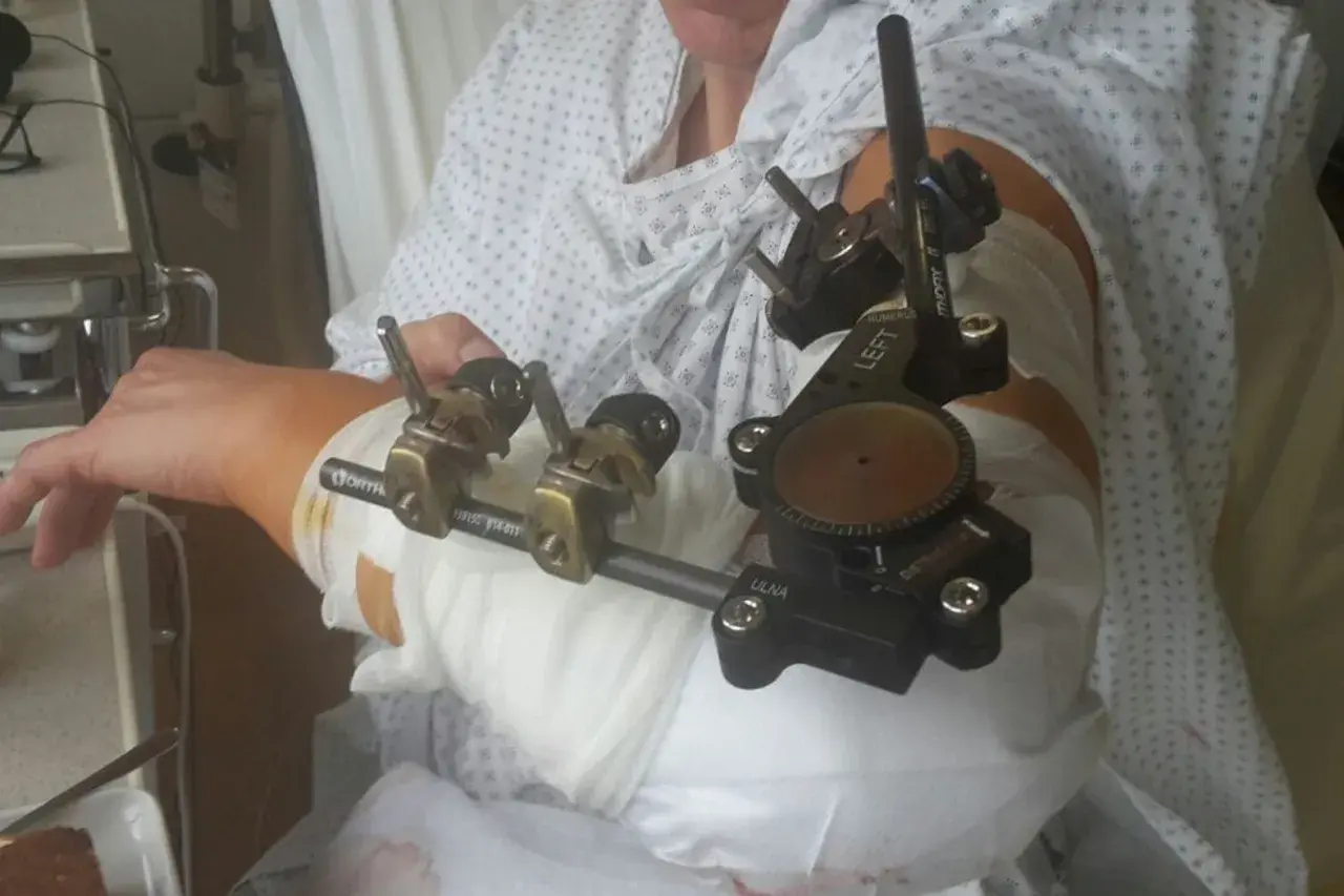 Ein Arm mit einem externen Fixateur, der für die Heilung nach einer Verletzung angelegt wurde. Dieses **halo medizin** Gerät stabilisiert den Knochen.