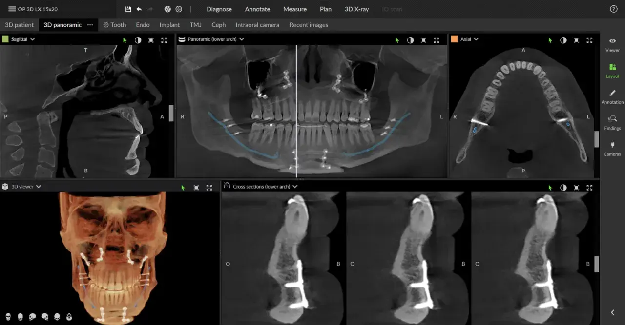 CBCT co to? Obraz przedstawia skany 3D szczęki i żuchwy z implantami, pokazujące szczegółową anatomię kości i zębów.