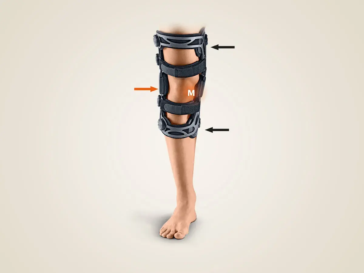 Ein Bein mit einer valgisierenden Orthese, die das Knie stabilisiert. Pfeile zeigen auf die Gelenke der Orthese.