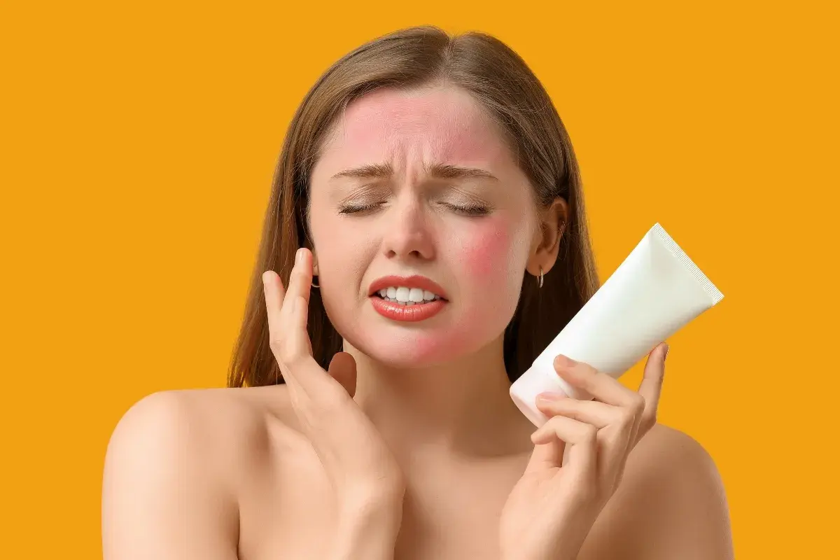 Donna con viso arrossato dal sole, che tiene in mano un tubetto di crema, cercando rimedi casalinghi per scottature da sole.