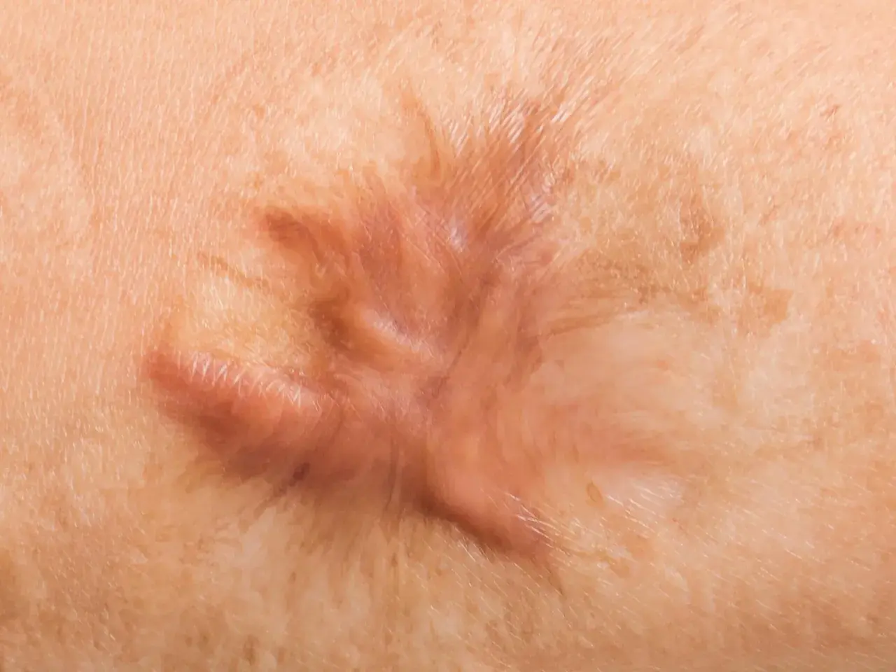 Gros plan d'une cicatrice hypertrophique sur la peau, ressemblant à une cloque sur cicatrice.