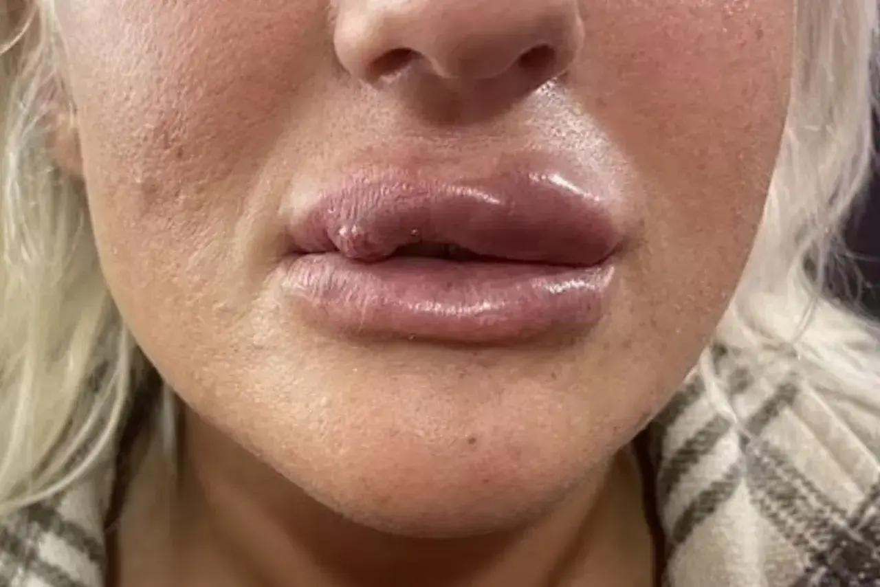 En närbild på en persons läppar och näsa, med synlig svullnad och en liten knöl på underläppen efter fillers.