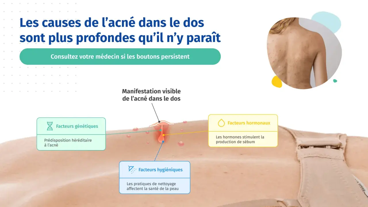 Illustration expliquant les causes de l'acné du dos chez l'adolescent : facteurs génétiques, hormonaux et hygiéniques.