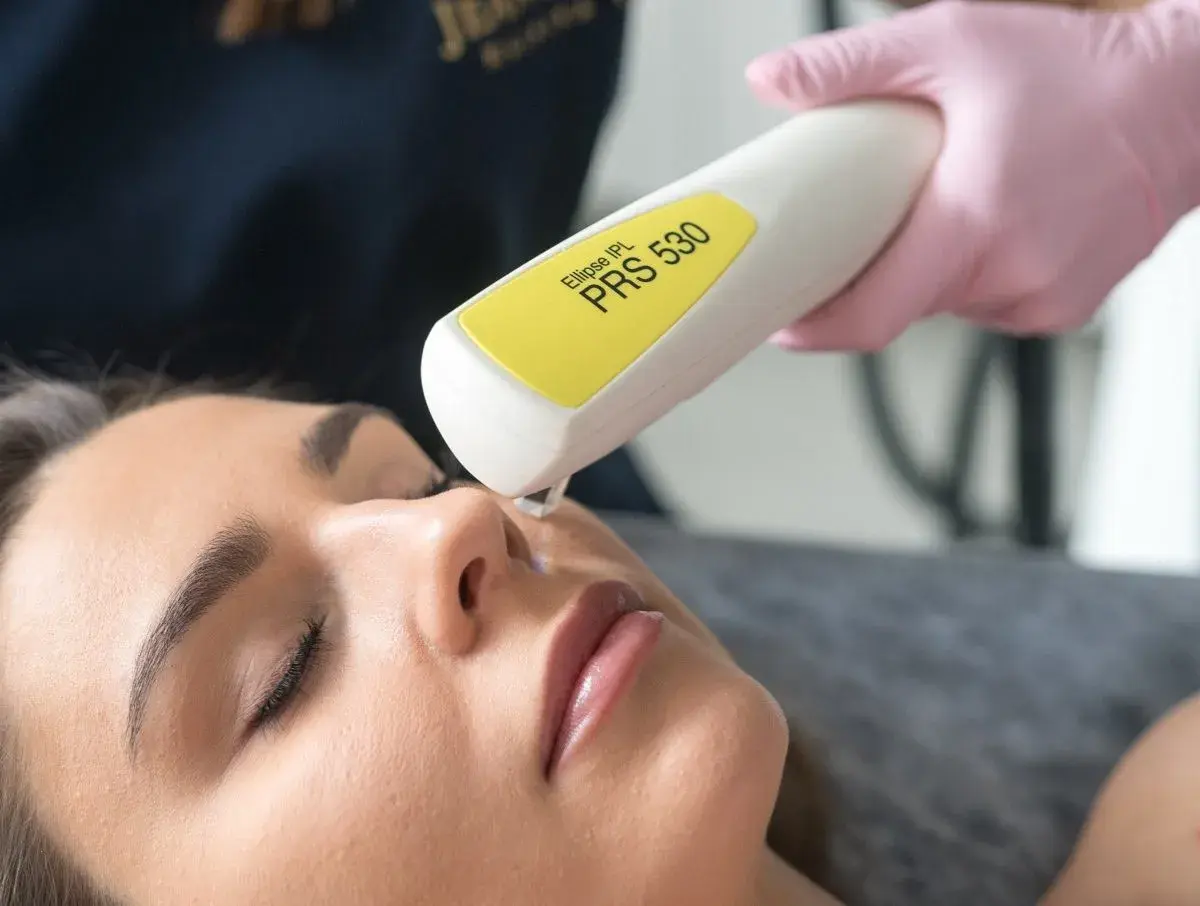 Zabiegi na naczynka na twarzy: laser IPL PRS 530 usuwa widoczne rumieńce i pajączki, przywracając skórze jednolity koloryt.