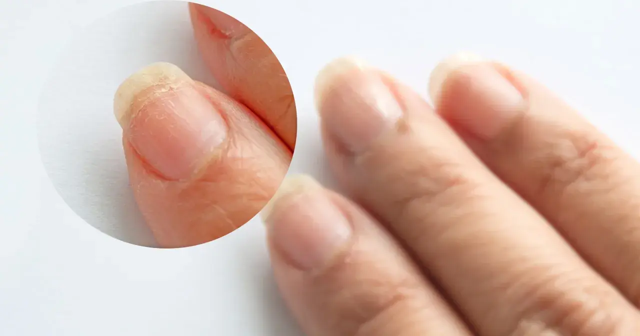 Paznokcie z łuszczącą się płytką, mogą być jednym z objawów wysokiego cholesterolu.