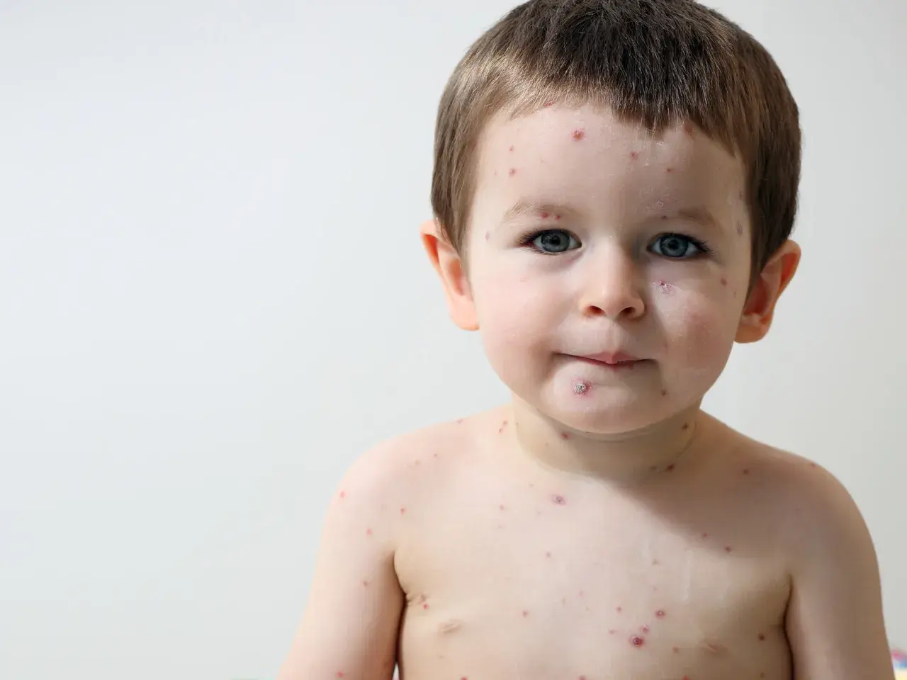 Bambino con macchie rosse sul viso e sul corpo, tipiche delle malattie esantematiche infantili.