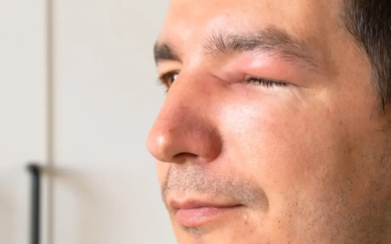 Un homme souffre d'une conjonctivite, son œil est visiblement gonflé et irrité.