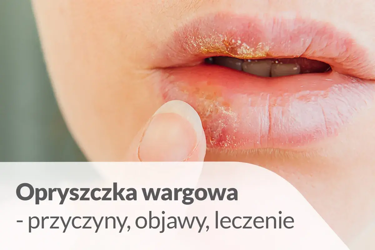 Opryszczka wargowa, jedna z chorób na ustach, objawia się pęcherzykami i strupkami. Palec zbliża się do ust.